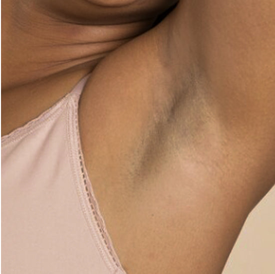 dark armpits
