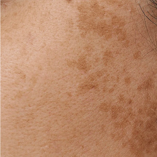 melasma